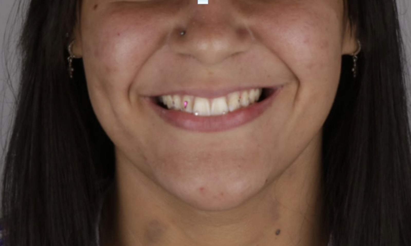 Jovem que deu golpe em dentista após colocar cristais nos dentes disse que nunca teve intenção de pagar: 'Não tinha dinheiro'