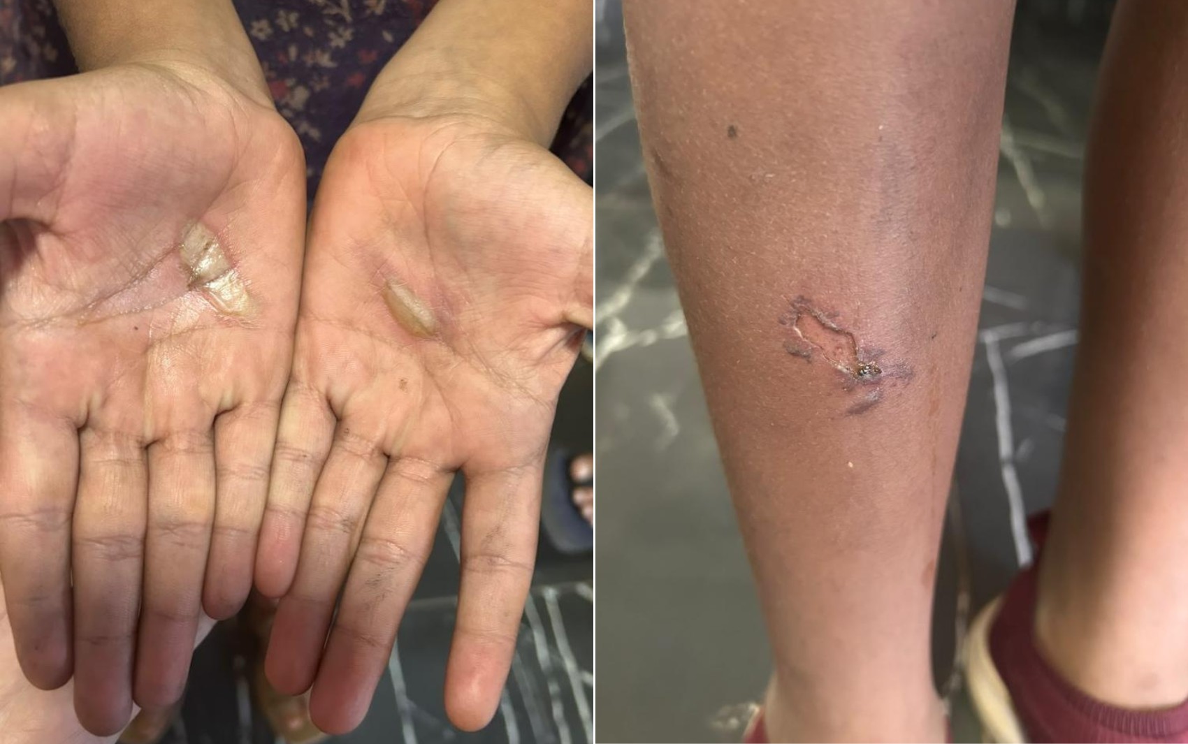 Pai é preso suspeito de queimar filhas após crianças quebrarem caixa de som acidentalmente