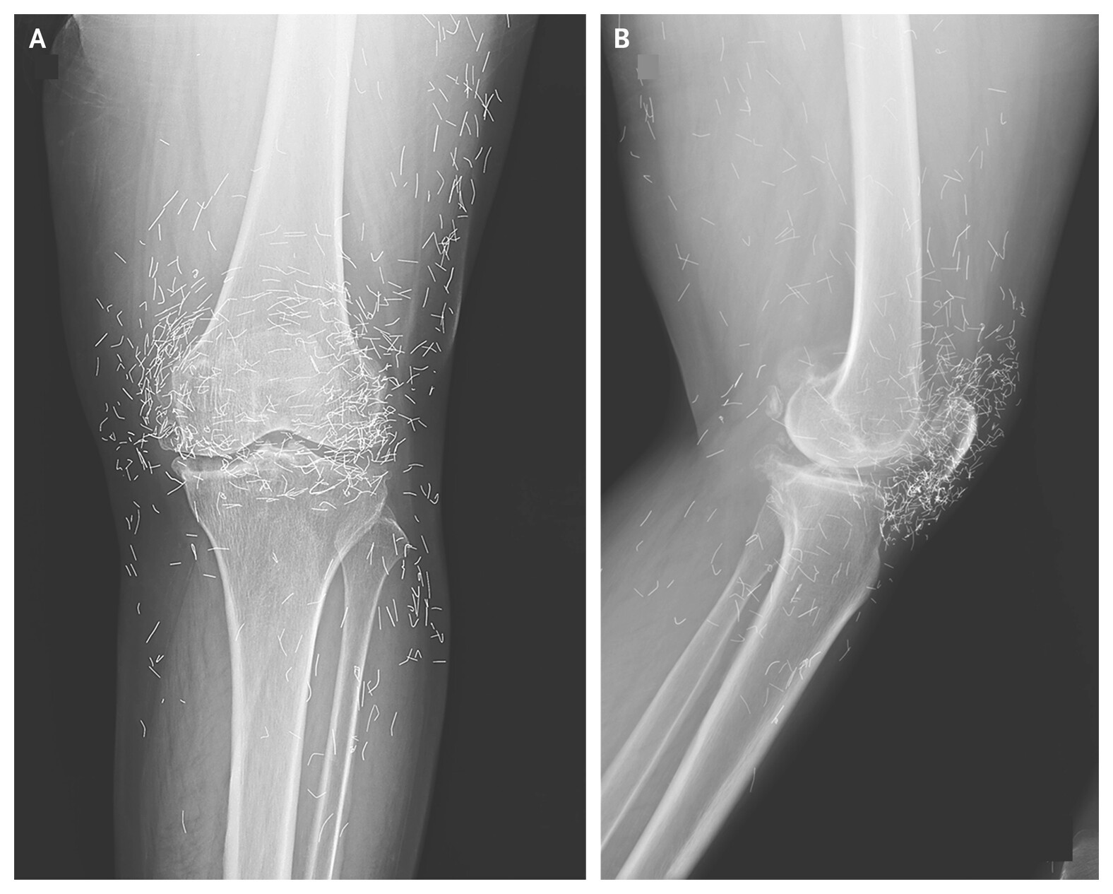 Raio-X revela fios de ouro no joelho de idosa e acende alerta sobre terapias sem evidência científica