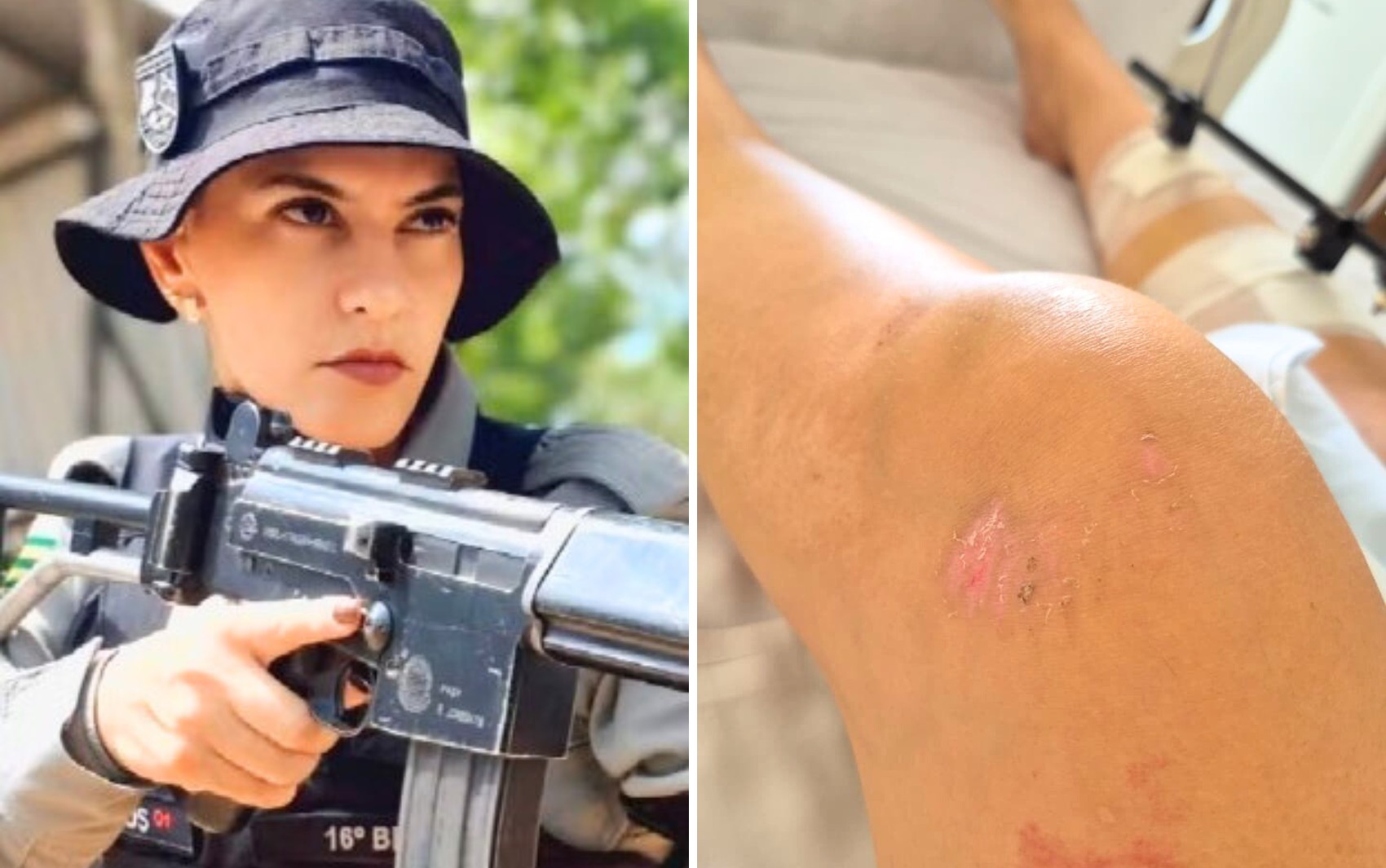 PM atropelada durante a abordagem diz ter perdido todos os ligamentos da perna direita: ‘Outra cirurgia para tentar refazer’