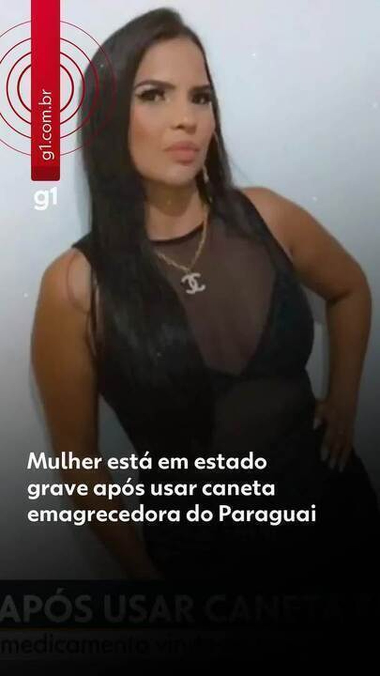 Síndrome de Guillain-Barré: entenda a doença