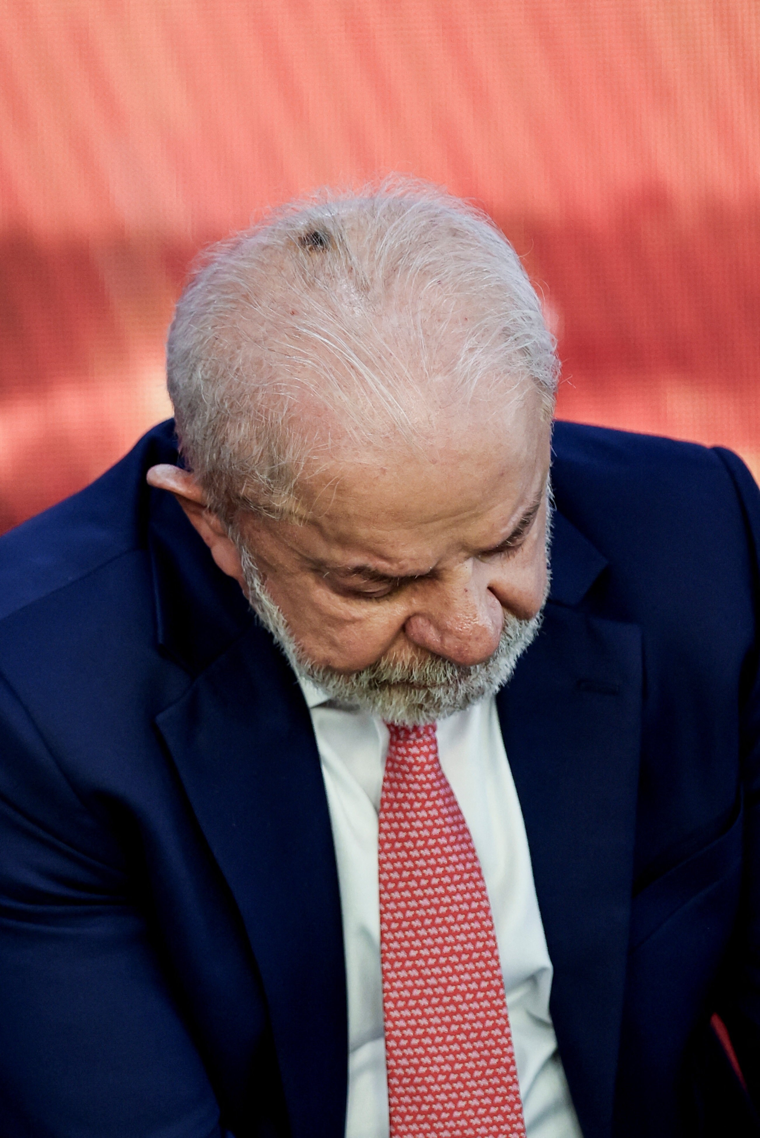 Queratose: Lula faz procedimento dermatológico simples e aparece com marca na cabeça; entenda a condição