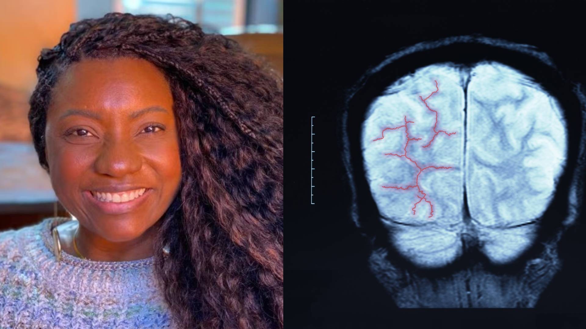 Aneurisma cerebral: sambista Adriana Araújo morre após passar mal e ser internada em BH