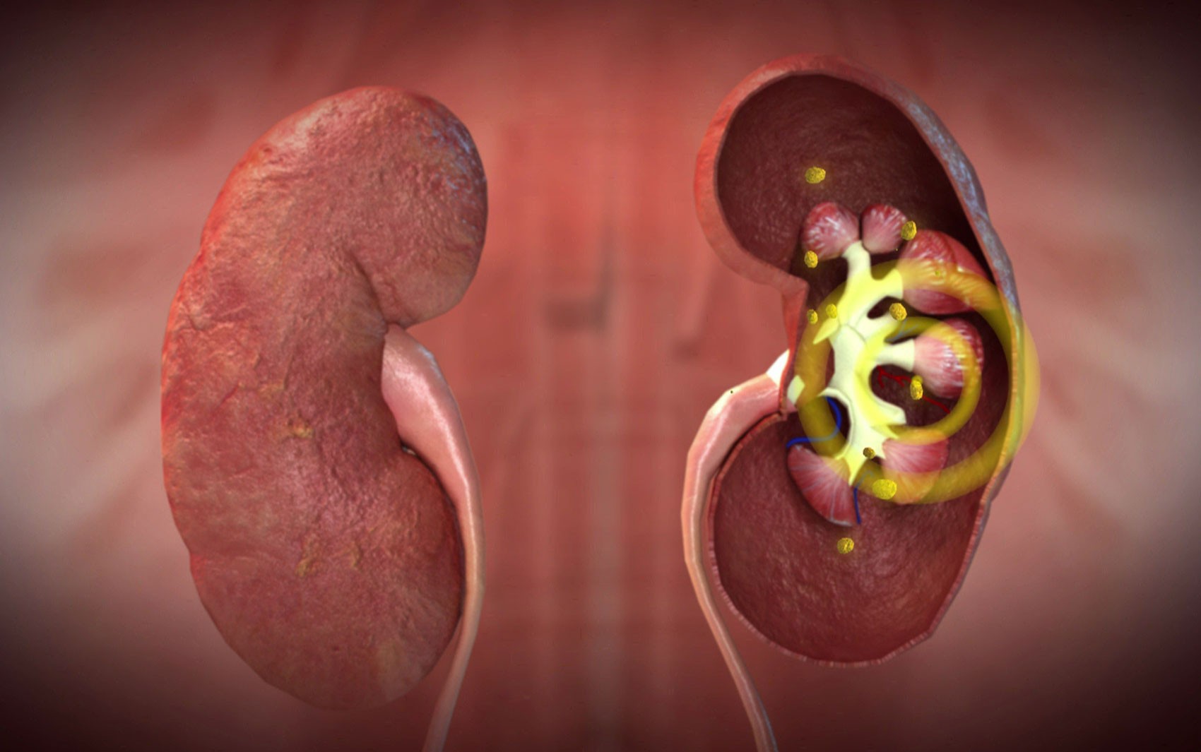 Bactérias são encontradas em cálculos renais mais comuns; estudo abre espaço para novos tratamentos