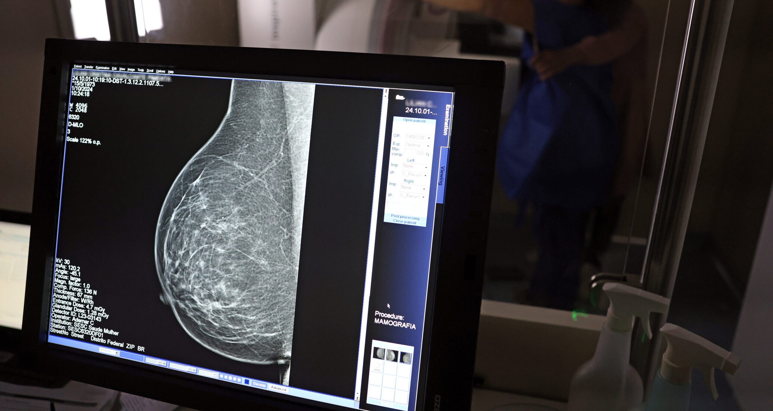 IA pode identificar risco de doenças cardíacas graves a partir de mamografias; entenda relação