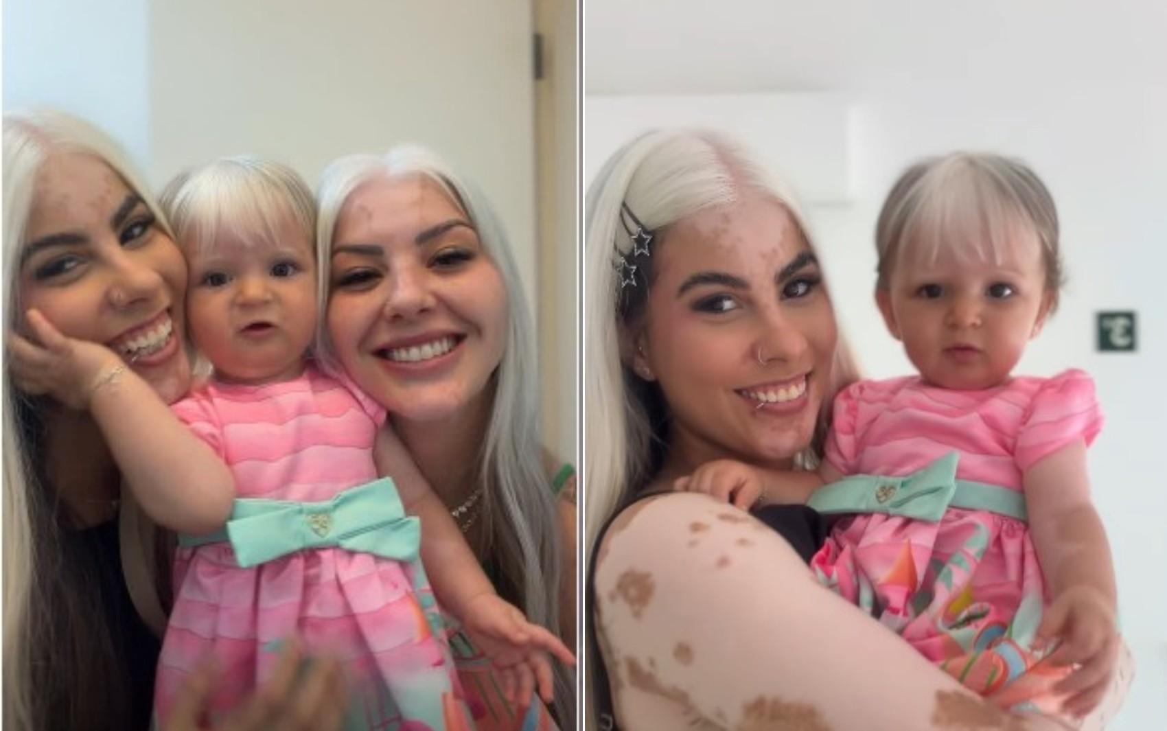 Influenciadora com alteração genética rara faz trend de 'rejuvenescimento' junto com amiga que tem a mesma condição