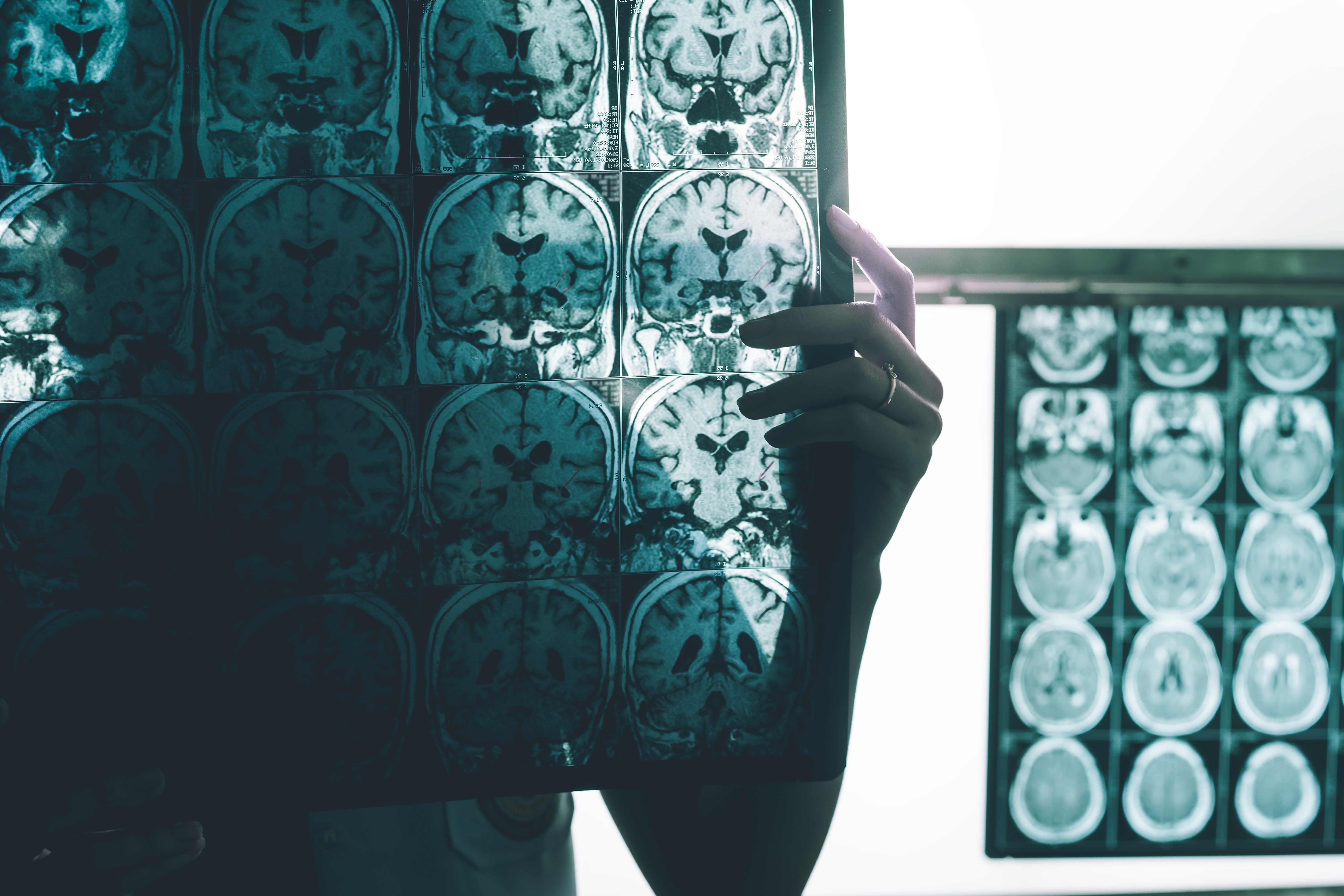 Proteína ligada ao Alzheimer se espalha pelo cérebro por conexões entre neurônios, mostra estudo