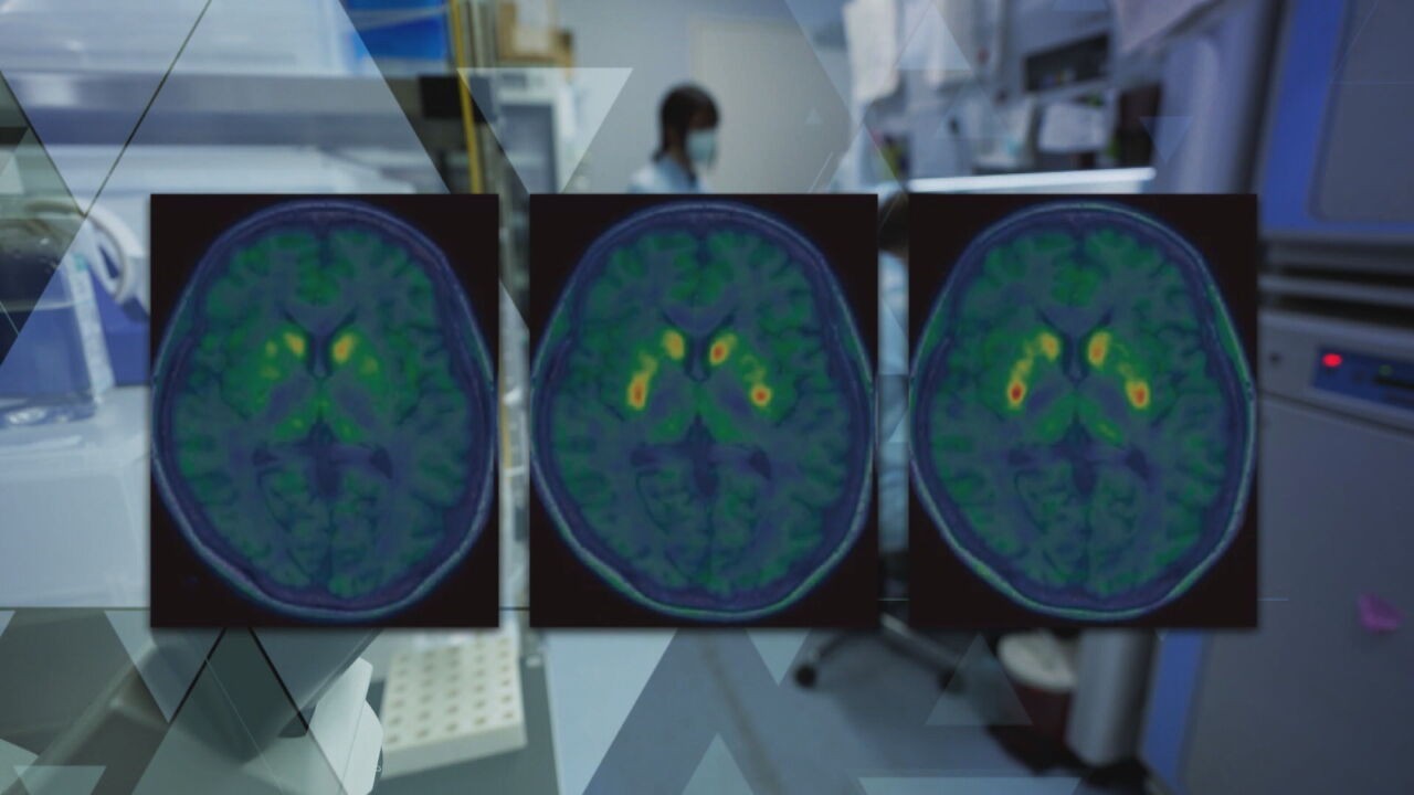 Como funciona a terapia celular que tenta restaurar a dopamina no cérebro de pacientes com Parkinson