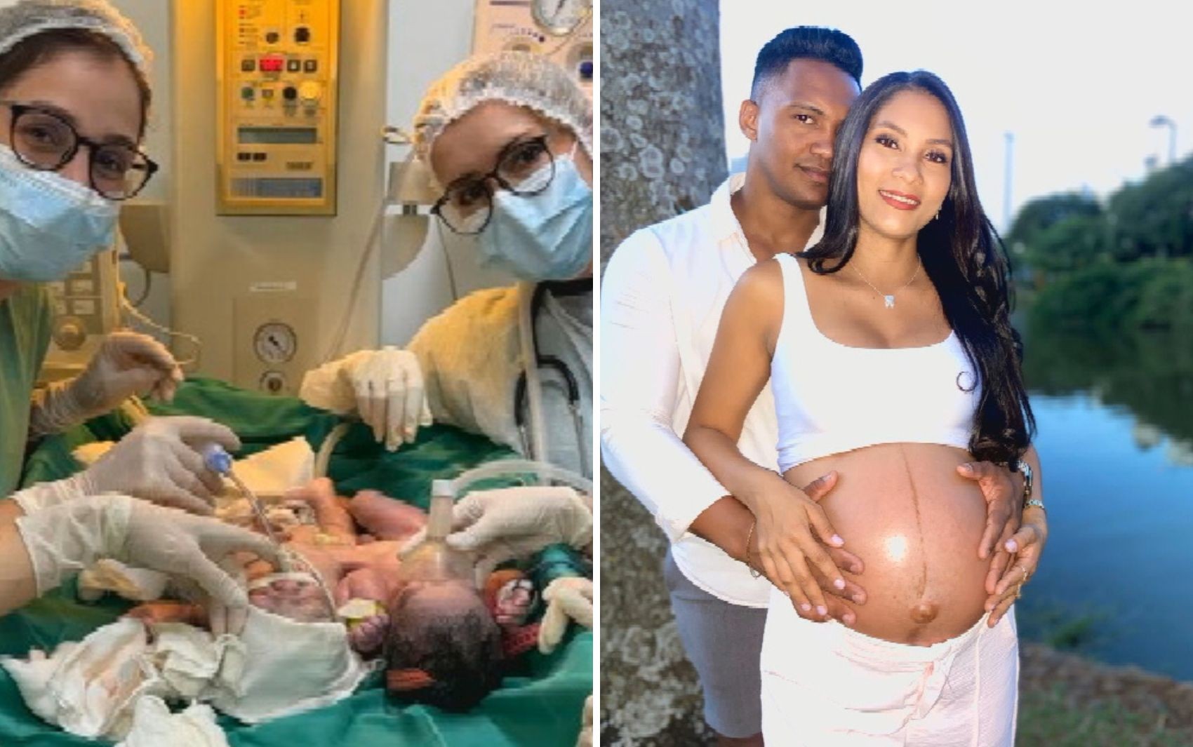 Bebês siameses unidos pelo abdômen nascem em Goiânia