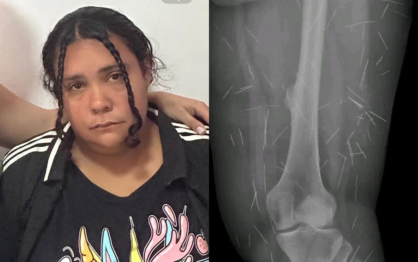 Mulher que fingiu ter 12 anos em SC para ser adotada tinha sido condenada em GO por falsidade ideológica após se passar por criança abusada