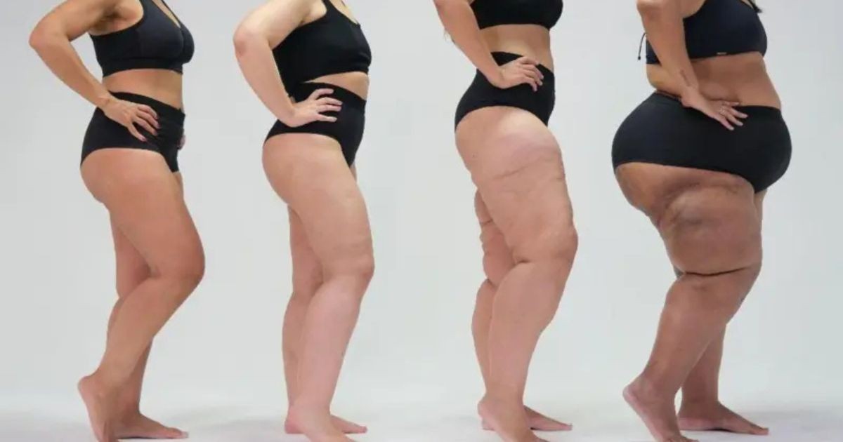 Lipedema: saiba mais sobre a doença confundida com obesidade e celulite