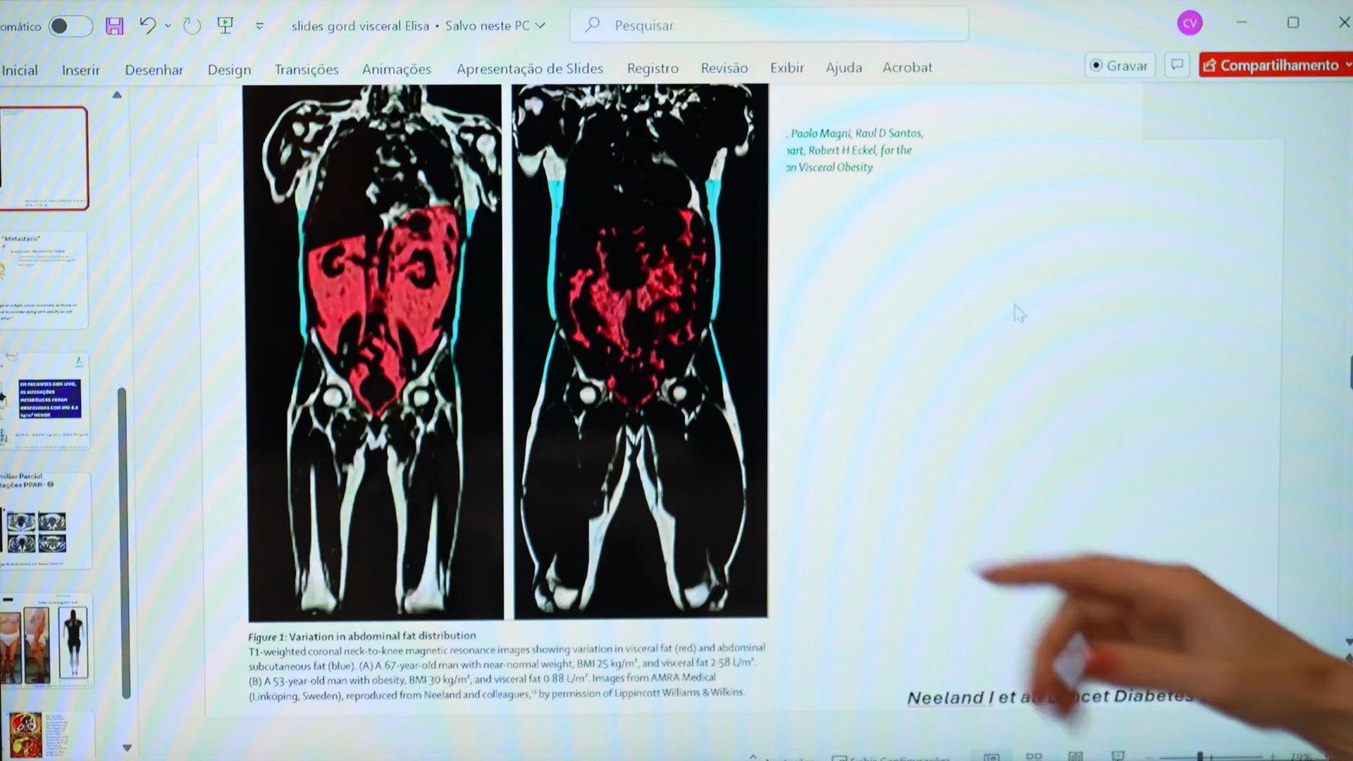 Como identificar a gordura visceral? Medida da cintura pode indicar risco