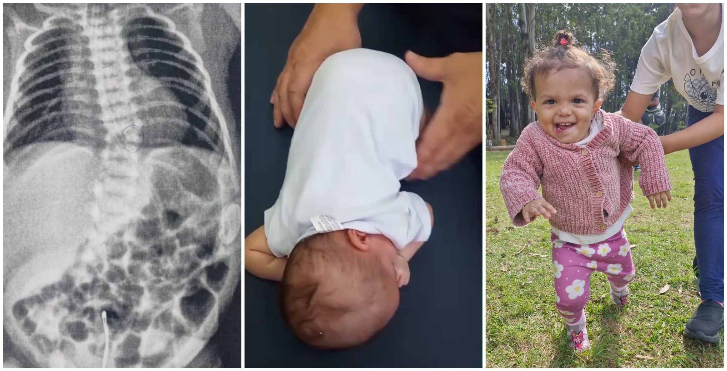 Como a fisioterapia precoce mudou a trajetória de bebê prematura com risco de não andar nem falar em SP