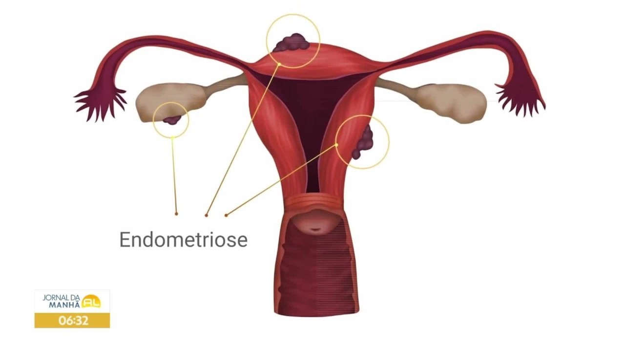 'Tomava morfina para a dor até que os médicos descobriram que eu tinha endometriose aos 13 anos'